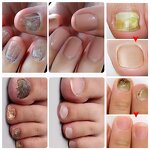 Nail Fungus Treatment Spray Manufacturer - 30ml 7 Days Solution Cuticle Care & Private Label