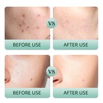 Skin Care Set Manufacturer - Tea Tree Salicylic Acid Anti-Pimple Cleanser Toner Essence