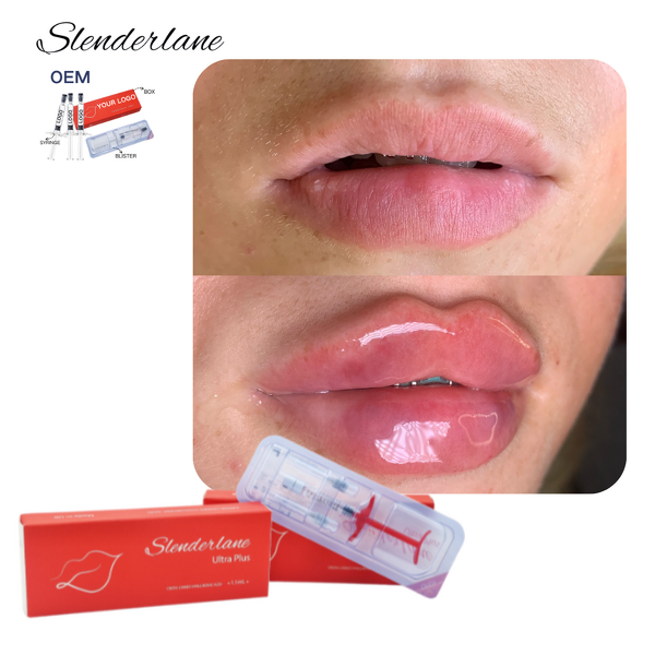 Dermal Filler Manufacturer - SLENDERLANE Cross Linked HA Lip Face Derm 1/1.1/10ml
