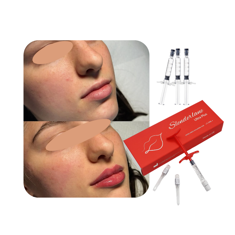 Dermal Filler Manufacturer - Cross Linked HA Facial Forehead Nose Lips Chin 1/10/20ml
