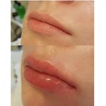 PDO Thread Manufacturer - Medical Mono Anti-wrinkle Face Eyebrow Lifting 60mm G