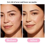 Pimple Patches Manufacturer - Private Label Cute Cartoon Hydrocolloid 36-Piece for Acne