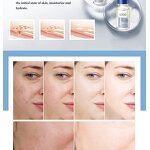 Skin Care Set Manufacturer - Natural Organic Liquid Acne Serum for Oil Control Deep Cleansing & OEM ODM Factory