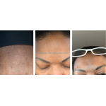 Chemical Face Peel Manufacturer - 30% Acid 30ml Pigmentation Whitening Anti-Wrinkle Stretch Marks