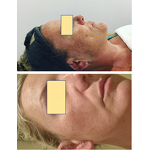 Skin Peel Acid Manufacturer - 30% Pigmentation Corrector Whitening Stretch Marks Black Skin