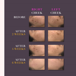 Kojic Acid Peel Exfoliator Manufacturer - 6% Liquid Dark Spot Hyper-Pigmentation Face Body