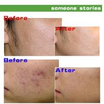 Skin Peel Acid Manufacturer - 30% Pigmentation Corrector Whitening Stretch Marks Black Skin