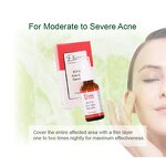 Benzoyl Peroxide Gel Manufacturer - 10% Sulfur Ultimate Pimples Blackheads Anti Acne