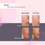 Kojic Acid Peel Exfoliator Manufacturer - 6% Liquid Dark Spot Hyper-Pigmentation Face Body