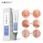 Acne Removal Cream Gel - Stretch Marks Desalt Quick Effective No Side Effects