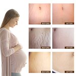 TCM Scar Repair Gel - Wholesale Acne Mark Removal Stretch Mark Skin Treatment