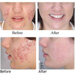 Acne Facial Serum - OEM Private Label Organic Skin Care Pimple Smoothing Liquid