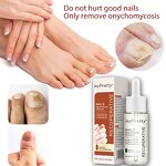 Toe Nail Fungus Gel - Fungal Treatment Whitening Anti Infection Foot Repair Liquid