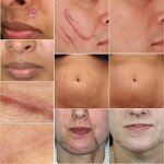 TCM Scar Repair Gel - Wholesale Acne Mark Removal Stretch Mark Skin Treatment