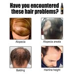 Hair Growth Cream Wholesale Supplier - Hot Sale Herbal Anti-Dandruff Anti Drop Roller Essential Oil Scalp Nourishing