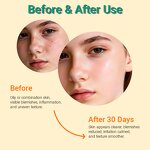 Salicylic Acid Blemish Serum - Private Label Teen Skin Fix Centella Acne Treatment Oily Vegan