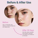 Teen Calming Toner - Private Label OEM Witch Hazel Centella Hydrating Soothing pH Balancing