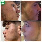 Men Clean Set - Private Label Oil Control Anti-Acne Face Wash Scrub Repairing Lotion