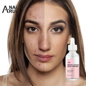 Acne Drying Lotion - OEM Private Label Hot Selling Pimple Scar Removal Calamine Serum