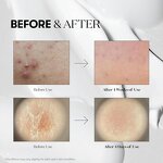 Korean Microneedling Serum - Private Label Reduce Acne Marks Tightening Hyaluronic Acid