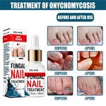Fungal Nail Destroyer - Best Seller Wholesale Effective Anti-Fungal Finger Toe Nail Repair