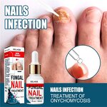 Fungal Nail Destroyer - Best Seller Wholesale Effective Anti-Fungal Finger Toe Nail Repair