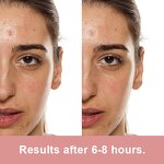 Acne Pimple Patch Manufacturer - Korean Hydrocolloid Salicylic Acid Facial for Spots