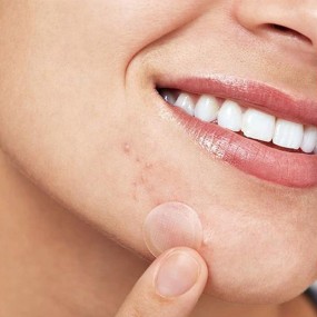 Micro Needle Acne Patches Factory - OEM Transparent Hyaluronic Acid