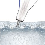 Tinysoft Nanosoft针工厂-3针34G透明质酸填充