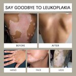 Vitiligo Ointment - Custom logo & Vitiliosis Sweat Spots Clearing