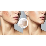 Scar Roll Supplier - Silicone Self-adhesive Waterproof