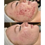 Microneedling Spicules Supplier - BIO Hyaluronic Acid Infused
