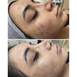 Microneedling Spicules Supplier - BIO Hyaluronic Acid Infused