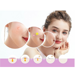 Pimple Patch Manufacturer - Hydrocolloid Acne Patches in Custom Shapes & Colors