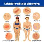 Jock Itch Relief Ointment Supplier - Wholesale Anti Itch Skin Cream