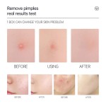 Acne Patch Manufacturer - Private Label Hydrocolloid Pimple Patch