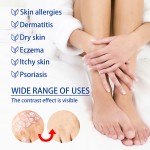 Jock Itch Relief Ointment Supplier - Wholesale Anti Itch Skin Cream