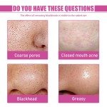 Blackhead Remover Supplier - Pores Cleaning Aloe Vera Treatment