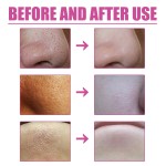 Blackhead Remover Supplier - Pores Cleaning Aloe Vera Treatment