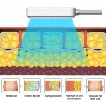 Cryoslimming Machine Supplier - EMS RF Fat Reduce