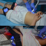 Cryoskin Machine Supplier - Thermal Cool Sculpting Device