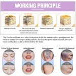 Picosecond Laser Machine Factory - Q Switch Tattoo Removal