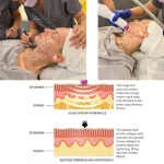RF Facial Device Manufacturer - Monopolar Collagen Stimulation
