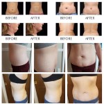 Slimming Machine Manufacturer - 80k RF Weight Loss