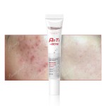 Facial Cream Manufacturer - Dark Spot Anti Acne Lightening