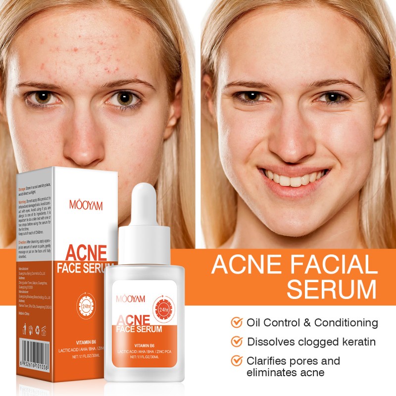 Acne Serum Supplier - AHA Salicylic Acid Oil Control Desalination