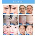 Plasma Device Manufacturer - Portable 2-in-1 Jet Acne Removal