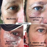 Laser Pen Factory - Korea Medical Ozone Face Lifting Jet Lift