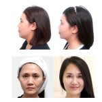 Face Lifting Machine Supplier - 2024 New Hot Sale RF Fractional