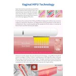 HIFU Machine Manufacturer - Vaginal Tightening Wireless Cartridges Rejuvenating